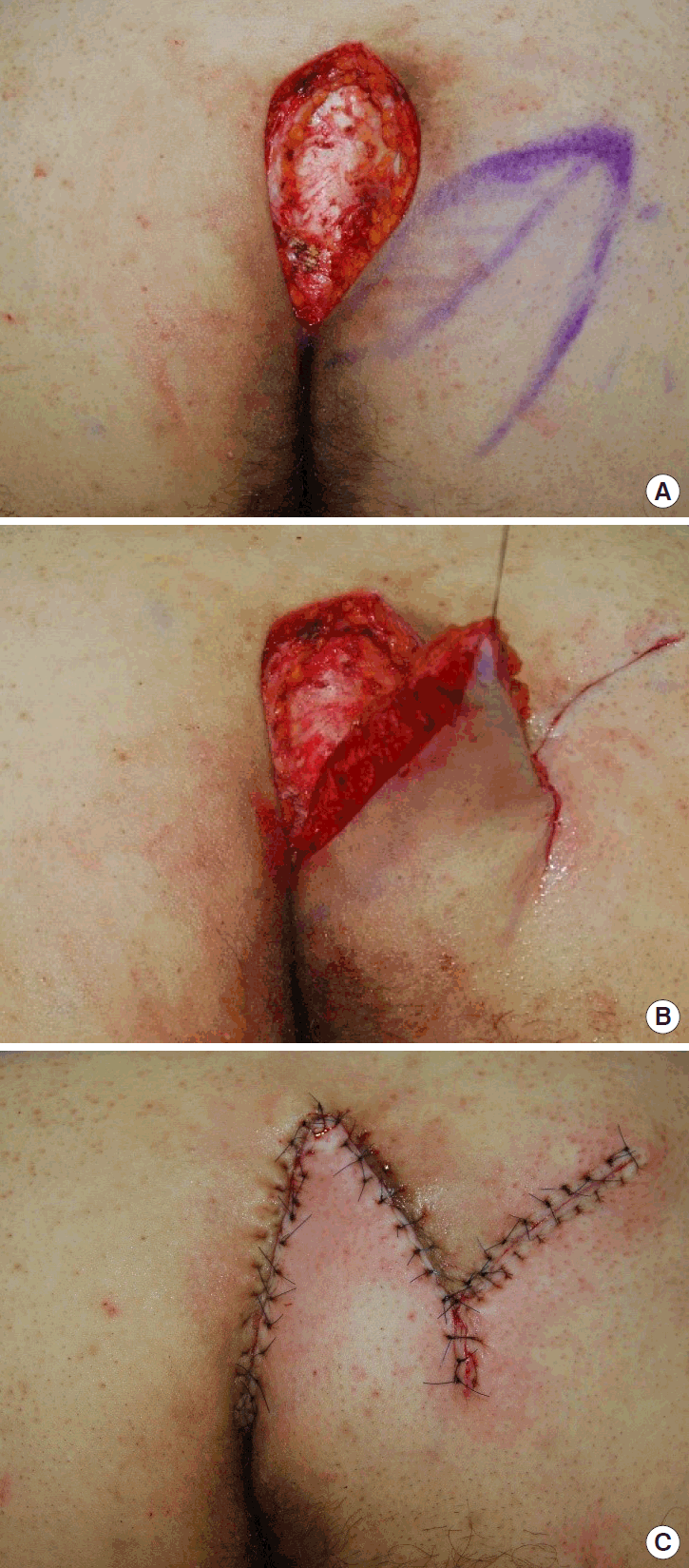Treating pilonidal sinus wounds with an antibacterial wound gel after  incision and drainage